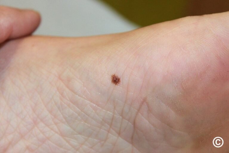 Understanding Acral Lentiginous Melanoma: Symptoms, Diagnosis, and Treatment